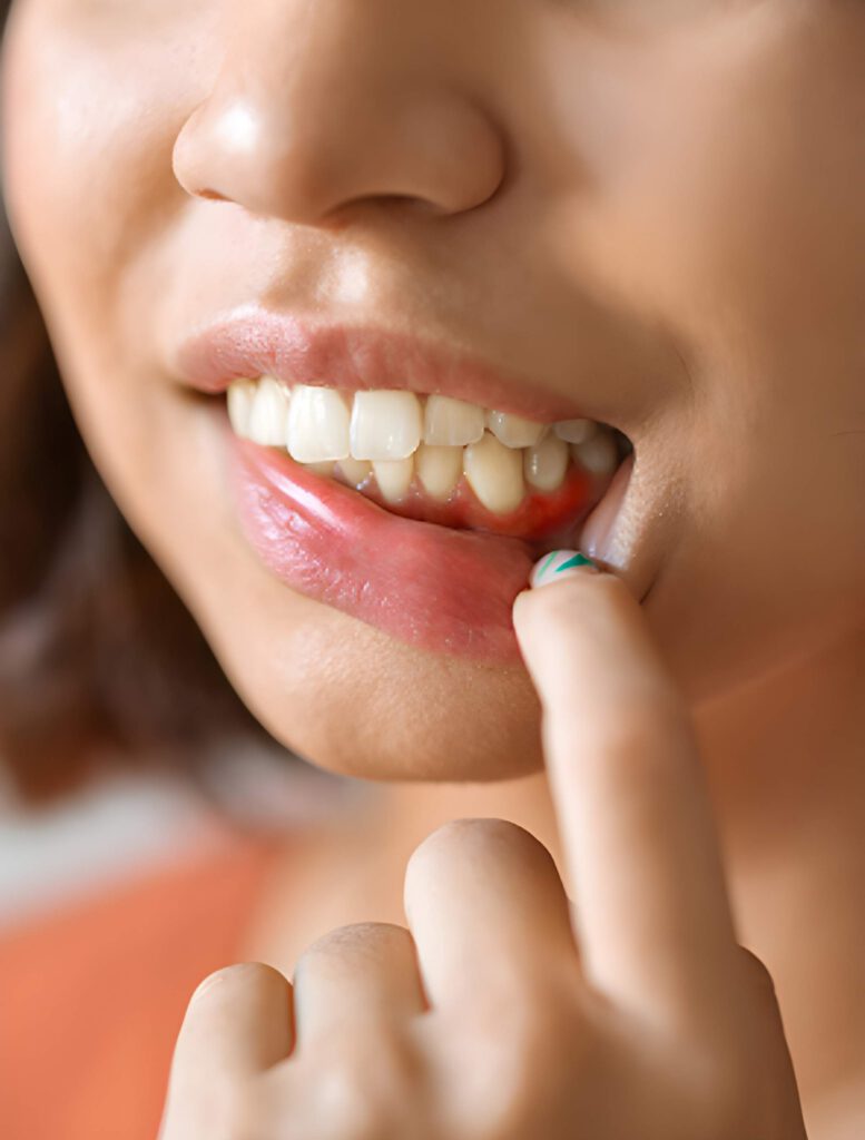 Inflamed gums